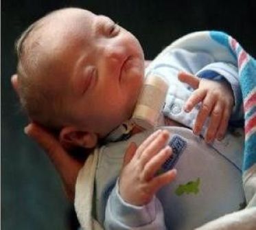 حالة بين كل 197 مليون مولود.. ولادة طفل دون أنف في أمريكا