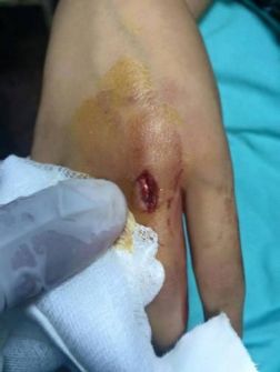 نابلس: رصاصة طائشة تصيب طفلة بجروح